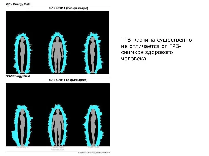ГРВ-картина существенно не отличается от ГРВ-снимков здорового человека