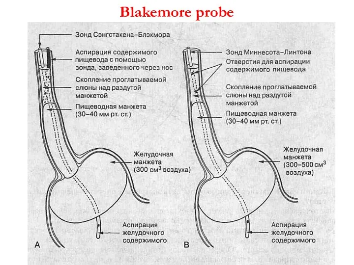 Blakemore probe