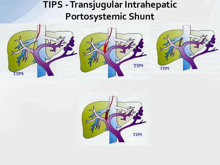 TIPS - Transjugular Intrahepatic Portosystemic Shunt