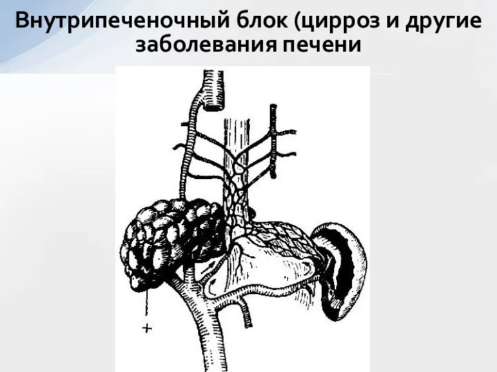 Внутрипеченочный блок (цирроз и другие заболевания печени