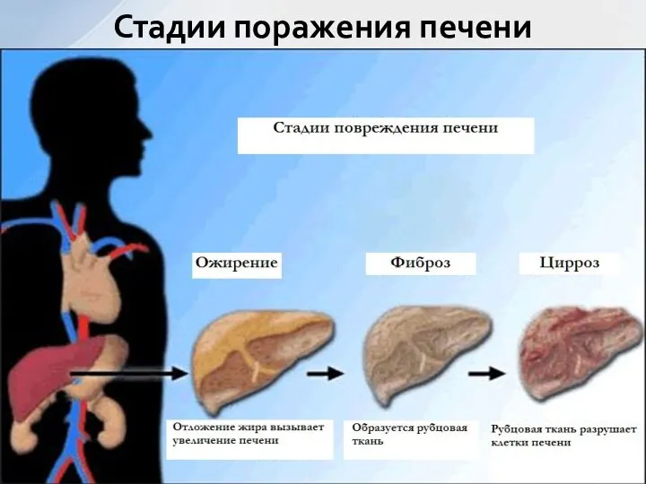 Стадии поражения печени