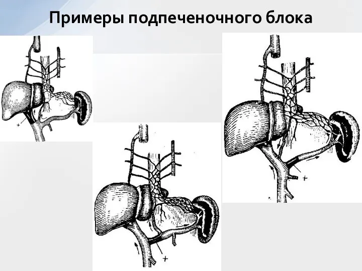 Примеры подпеченочного блока