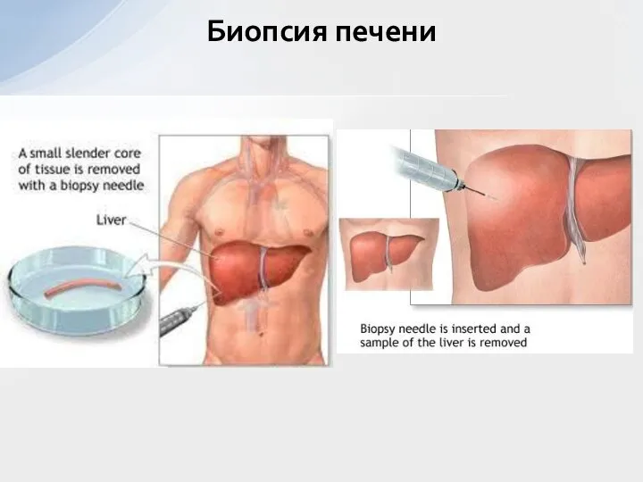 Биопсия печени