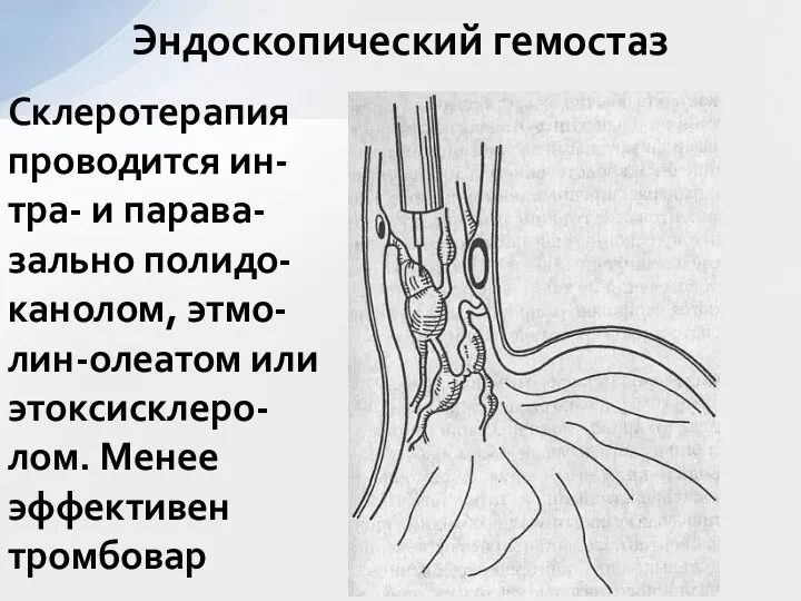 Эндоскопический гемостаз Склеротерапия проводится ин-тра- и парава-зально полидо-канолом, этмо-лин-олеатом или этоксисклеро-лом. Менее эффективен тромбовар