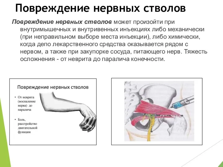 Повреждение нервных стволов Повреждение нервных стволов может произойти при внутримышечных и внутривенных