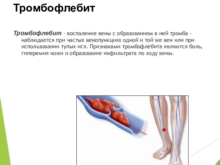 Тромбофлебит Тромбофлебит - воспаление вены с образованием в ней тромба - наблюдается