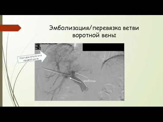 Эмболизация/перевязка ветви воротной вены Контуры опухоли в правой доле эмболы