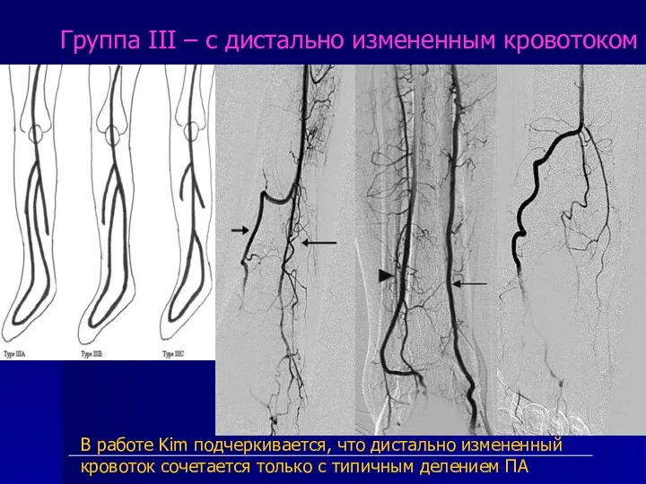 Группа III – с дистально измененным кровотоком В работе Kim подчеркивается, что