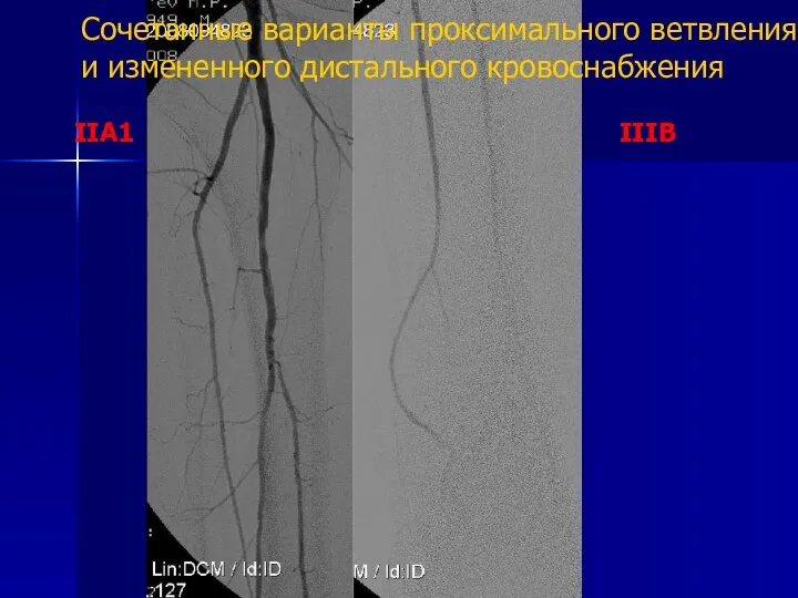 Сочетанные варианты проксимального ветвления и измененного дистального кровоснабжения IIA1 IIIB