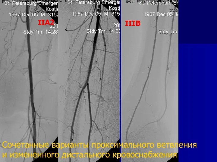 Сочетанные варианты проксимального ветвления и измененного дистального кровоснабжения IIA2 IIIB