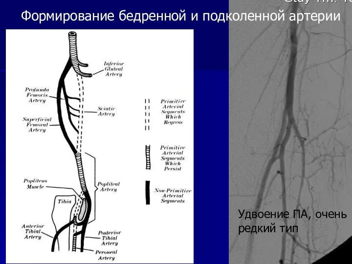 Формирование бедренной и подколенной артерии Удвоение ПА, очень редкий тип