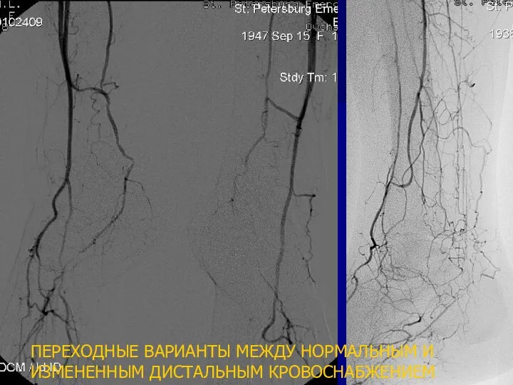 ПЕРЕХОДНЫЕ ВАРИАНТЫ МЕЖДУ НОРМАЛЬНЫМ И ИЗМЕНЕННЫМ ДИСТАЛЬНЫМ КРОВОСНАБЖЕНИЕМ