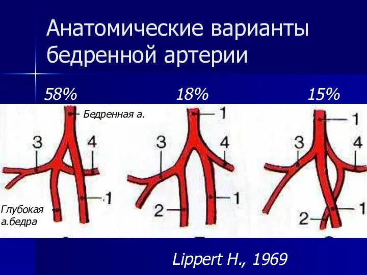 Анатомические варианты бедренной артерии Бедренная а. Глубокая а.бедра Lippert H., 1969 58% 18% 15%