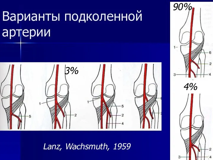 Варианты подколенной артерии Lanz, Wachsmuth, 1959 90% 4% 3%