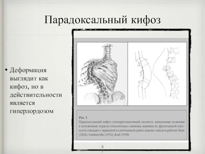 Парадоксальный кифоз Деформация выглядит как кифоз, но в действительности является гиперлордозом