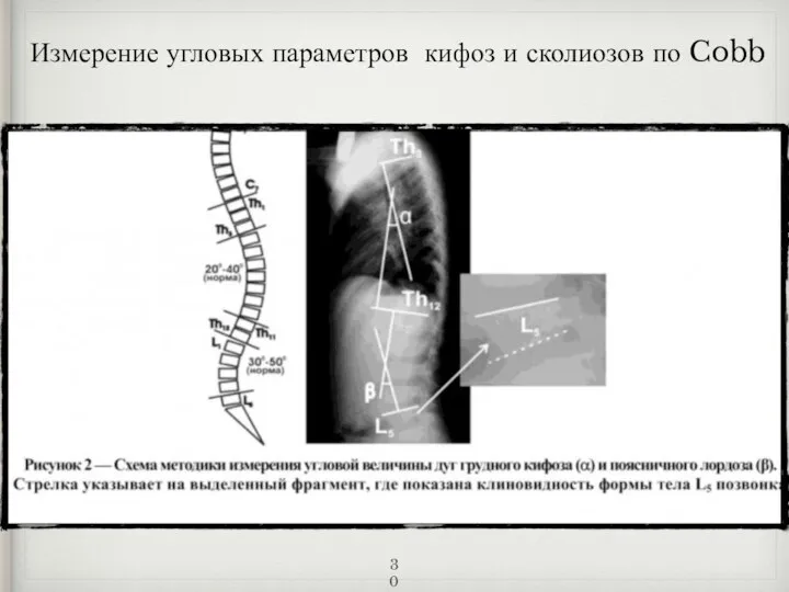Измерение угловых параметров кифоз и сколиозов по Cobb