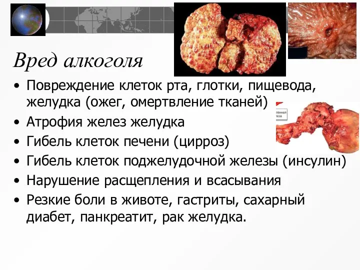 Вред алкоголя Повреждение клеток рта, глотки, пищевода, желудка (ожег, омертвление тканей) Атрофия