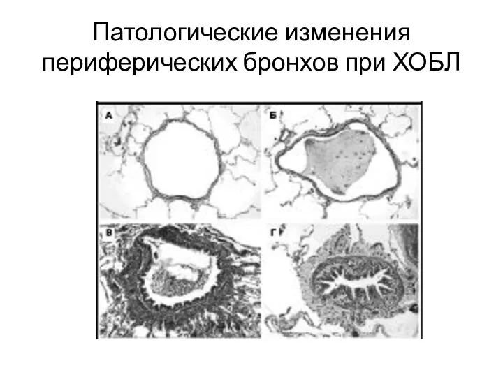 Патологические изменения периферических бронхов при ХОБЛ