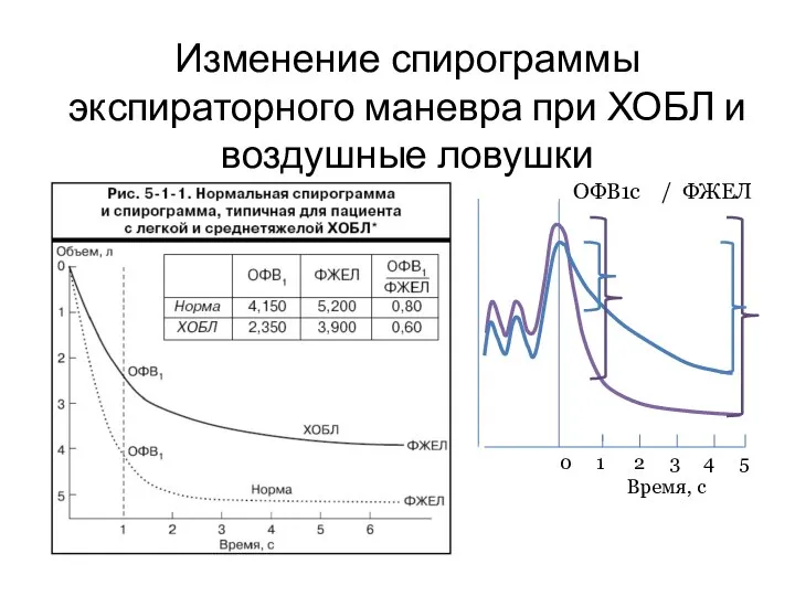 Изменение спирограммы экспираторного маневра при ХОБЛ и воздушные ловушки 0 1 2