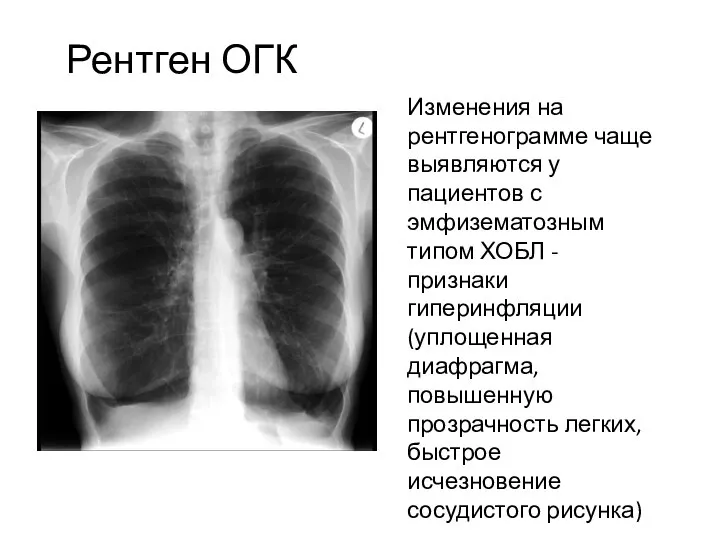 Рентген ОГК Изменения на рентгенограмме чаще выявляются у пациентов с эмфизематозным типом