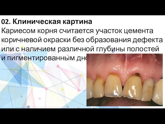 02. Клиническая картина Кариесом корня считается участок цемента коричневой окраски без образования