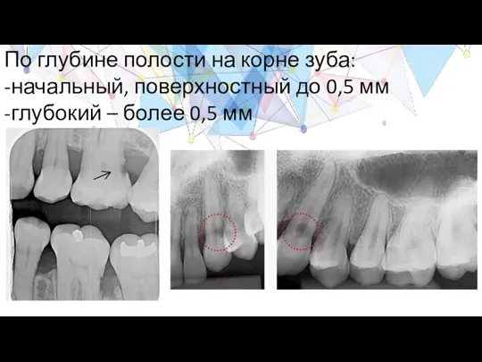 По глубине полости на корне зуба: -начальный, поверхностный до 0,5 мм -глубокий – более 0,5 мм