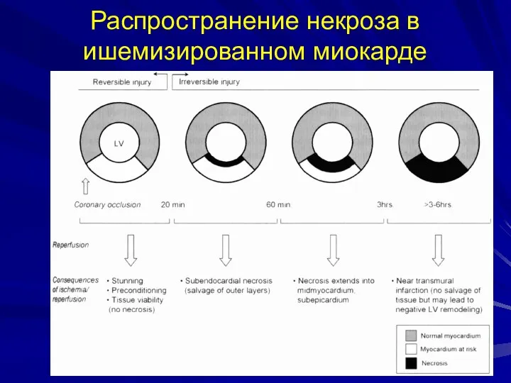 Распространение некроза в ишемизированном миокарде