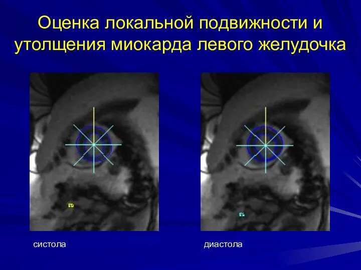 Оценка локальной подвижности и утолщения миокарда левого желудочка систола диастола