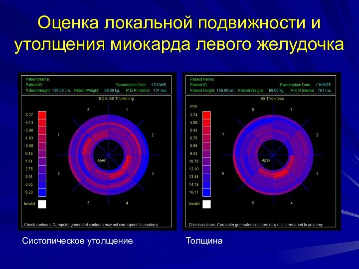 Оценка локальной подвижности и утолщения миокарда левого желудочка Систолическое утолщение Толщина