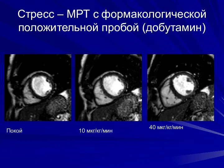 Стресс – МРТ с формакологической положительной пробой (добутамин) Покой 10 мкг/кг/мин 40 мкг/кг/мин