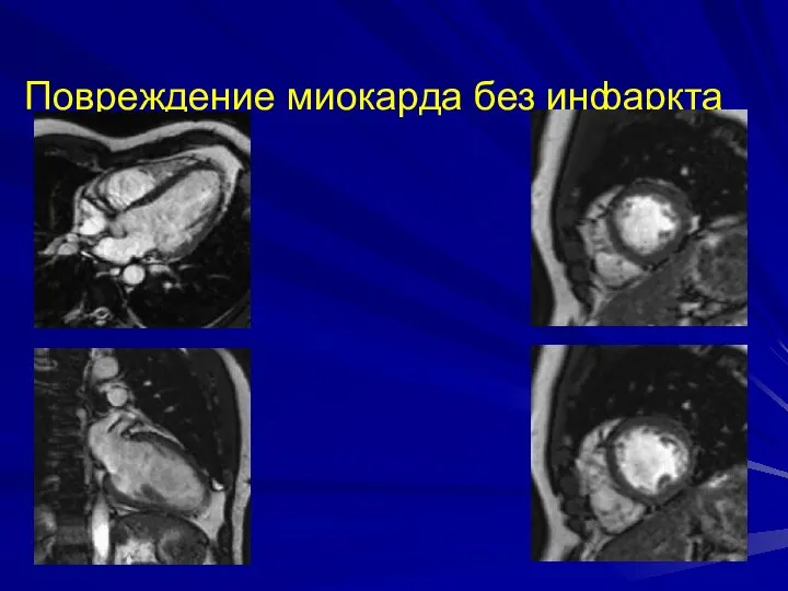 Повреждение миокарда без инфаркта