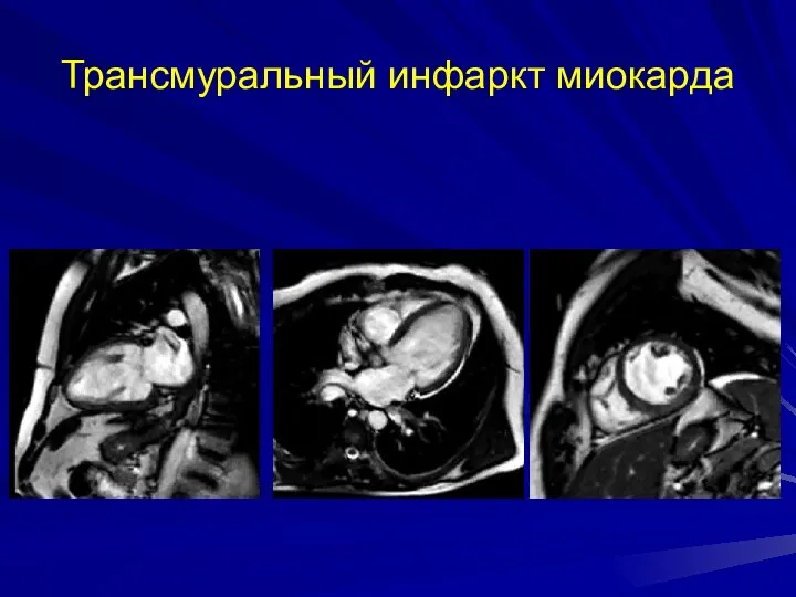 Трансмуральный инфаркт миокарда