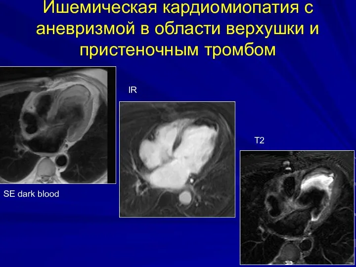 Ишемическая кардиомиопатия с аневризмой в области верхушки и пристеночным тромбом SE dark blood IR T2