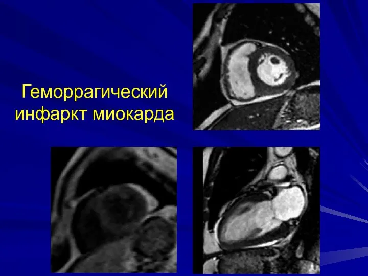 Геморрагический инфаркт миокарда