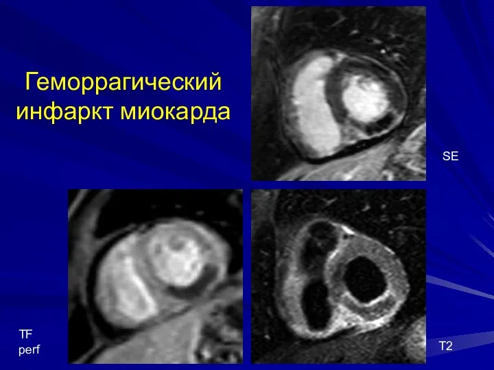 Геморрагический инфаркт миокарда SE T2 TF perf