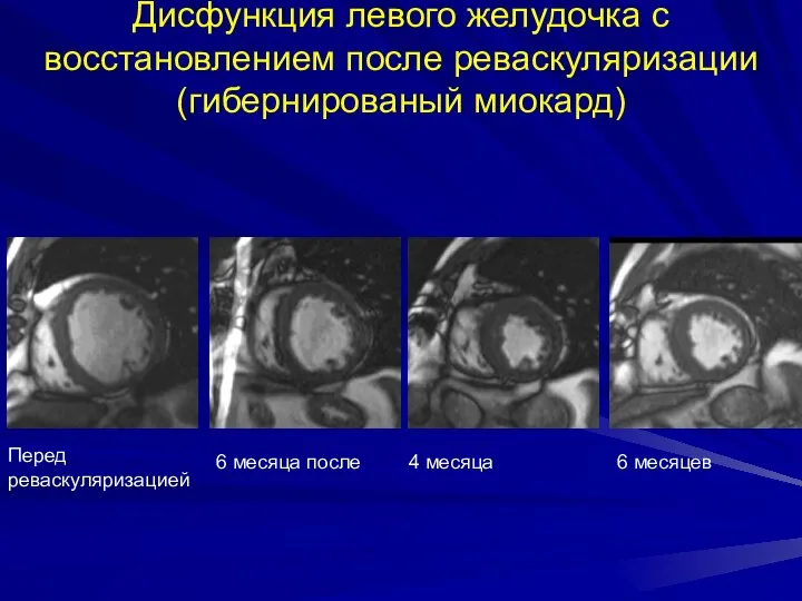 Дисфункция левого желудочка с восстановлением после реваскуляризации (гибернированый миокард) 6 месяцев 4