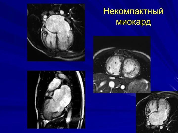 Некомпактный миокард