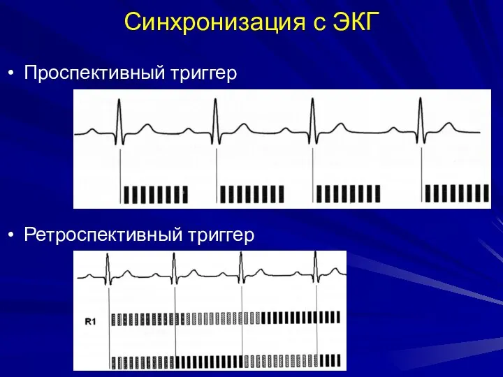 Синхронизация с ЭКГ Проспективный триггер Ретроспективный триггер