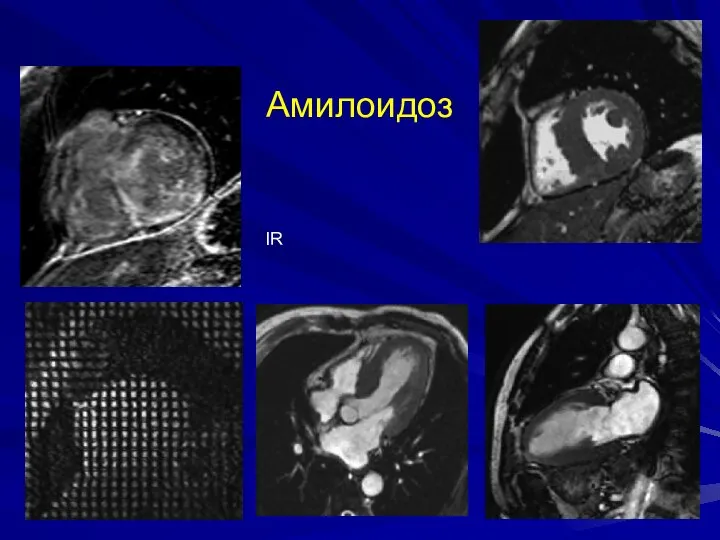 Амилоидоз IR