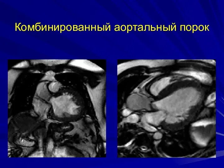 Комбинированный аортальный порок