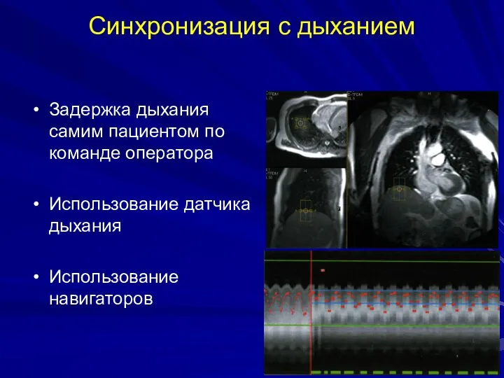 Синхронизация с дыханием Задержка дыхания самим пациентом по команде оператора Использование датчика дыхания Использование навигаторов