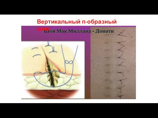 Вертикальный п-образный шов