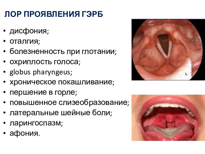 ЛОР ПРОЯВЛЕНИЯ ГЭРБ дисфония; оталгия; болезненность при глотании; охриплость голоса; globus pharyngeus;