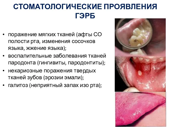 СТОМАТОЛОГИЧЕСКИЕ ПРОЯВЛЕНИЯ ГЭРБ поражение мягких тканей (афты СО полости рта, изменения сосочков