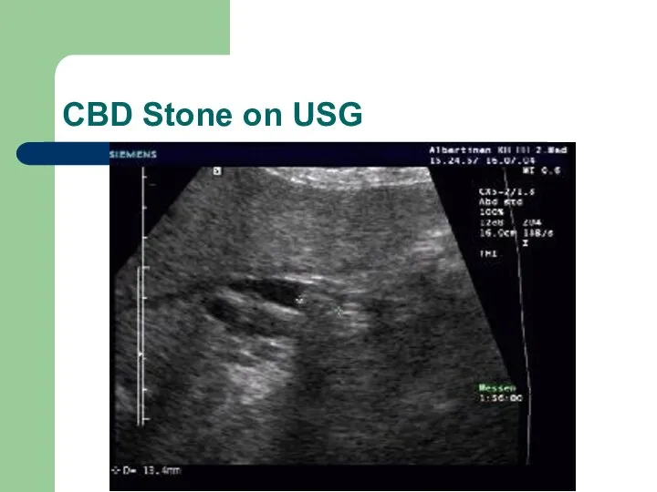 CBD Stone on USG