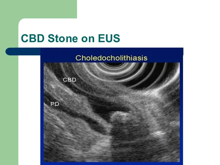 CBD Stone on EUS
