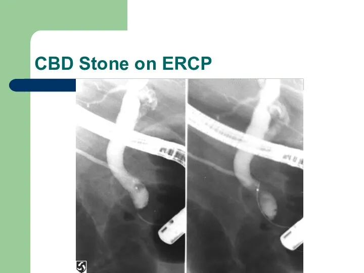 CBD Stone on ERCP