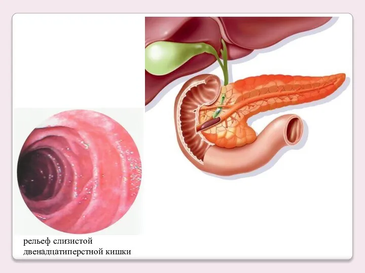 рельеф слизистой двенадцатиперстной кишки