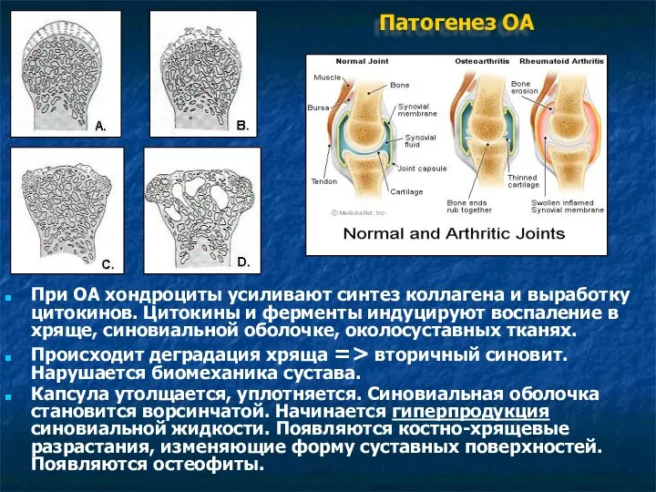 Патогенез ОА При ОА хондроциты усиливают синтез коллагена и выработку цитокинов. Цитокины