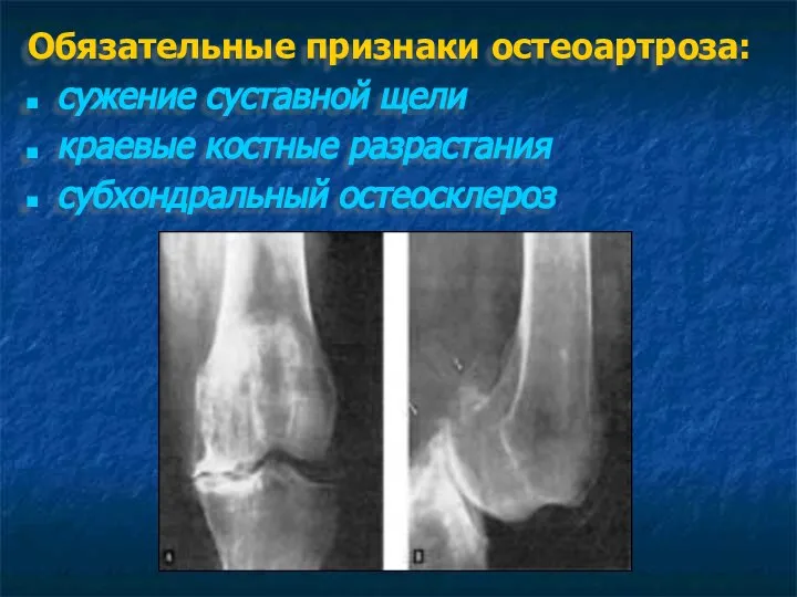 Обязательные признаки остеоартроза: сужение суставной щели краевые костные разрастания субхондральный остеосклероз